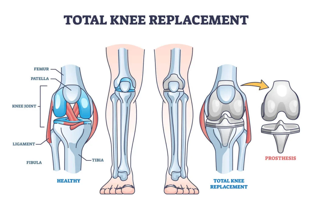 Total Knee Replacement Surgery Abroad